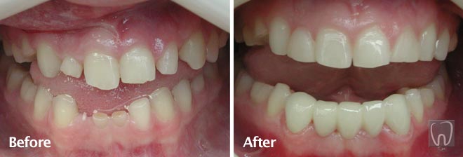All Ceramic Bridge by Black & Black Dental, Willow Street Lancaster PA Pennsylvania dentist