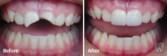 All Porcelain Crowns by Black & Black Dental, Willow Street Lancaster PA Pennsylvania dentist