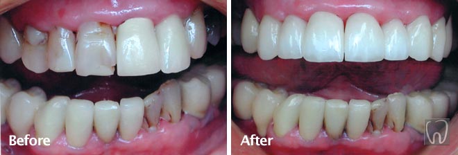 Anterior Porcelain Crowns by Black & Black Dental, Willow Street Lancaster PA Pennsylvania dentist