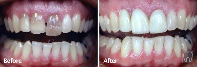 Anterior Porcelain Crowns by Black & Black Dental, Willow Street Lancaster PA Pennsylvania dentist