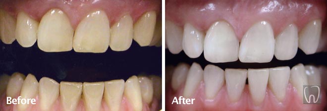 Bleaching Whitening by Black & Black Dental, Willow Street Lancaster PA Pennsylvania dentist