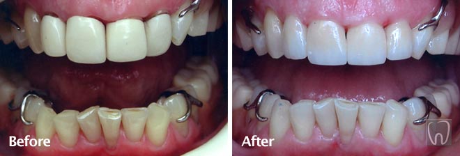 Tooth Whitening and Front Crowns by Black & Black Dental, Willow Street Lancaster PA Pennsylvania dentist